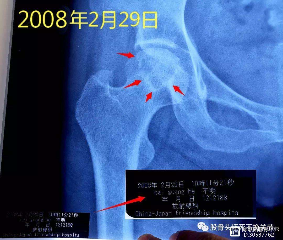 龙岩人工骨头医保报销多少(人工骨头医保报销多少比例)